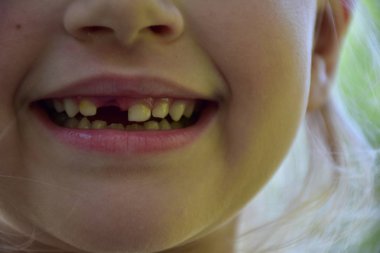 Bir çocuktan bir diş düştü.