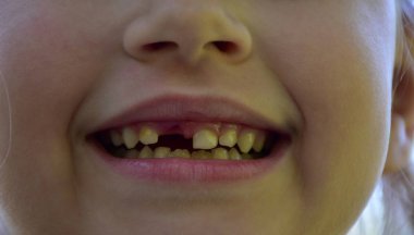 Bir çocuktan bir diş düştü.