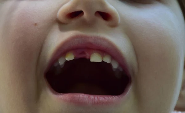 아이의 이빨이 떨어져 나갔습니다 — 스톡 사진