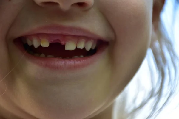 一颗从小孩身上掉下来的牙 — 图库照片