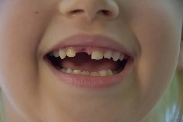 Ребенка Выпал Зуб — стоковое фото