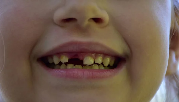 Einem Kind Fiel Ein Zahn Aus — Stockfoto