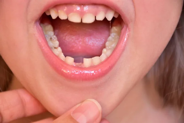 Tooth Fell Out Child — Stock Photo, Image