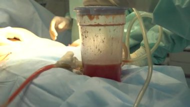 yağ kaldırma ve Liposuction cerrahisi Yağ arayan. liposuction sonra tencerede insan yağı. Ameliyat sırasında fazla kalori leri boşaltın.