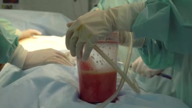 yağ kaldırma ve Liposuction cerrahisi Yağ arayan. liposuction sonra tencerede insan yağı. Ameliyat sırasında fazla kalori leri boşaltın.