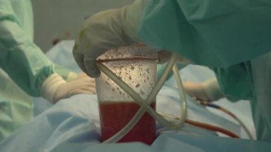 yağ kaldırma ve Liposuction cerrahisi Yağ arayan. liposuction sonra tencerede insan yağı. Ameliyat sırasında fazla kalori leri boşaltın.