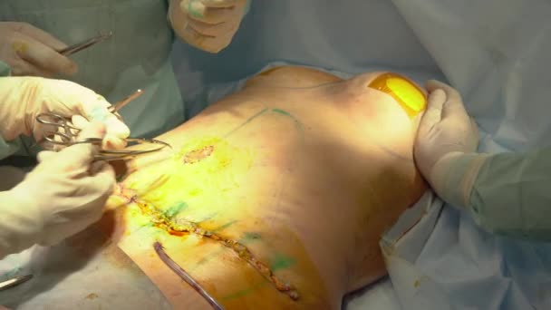 Surgeon doing surgical suture or stitches on belly after liposuction. Female patient under general anesthesia. — Stock Video