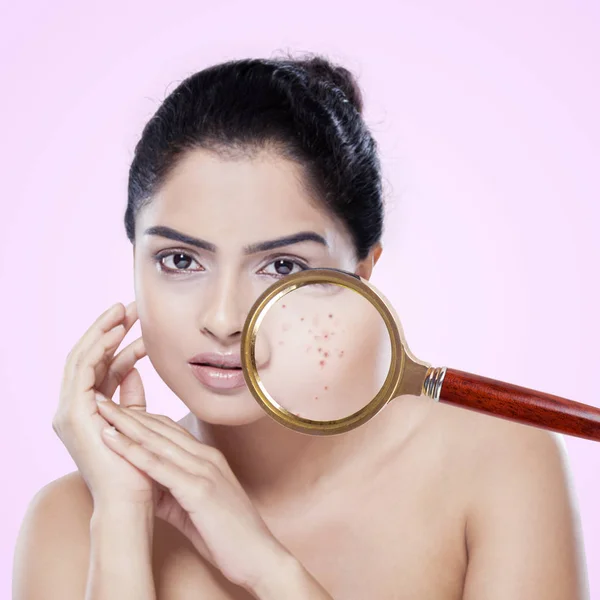 Mulher indiana bonita com pele de acne — Fotografia de Stock