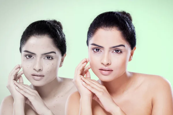 Indisk kvinna före och efter kosmetisk behandling — Stockfoto