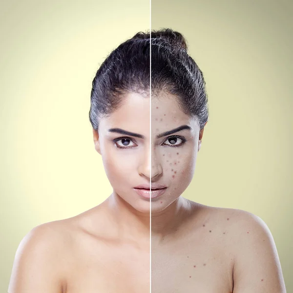 Mulher jovem antes e depois de cuidados com a pele — Fotografia de Stock