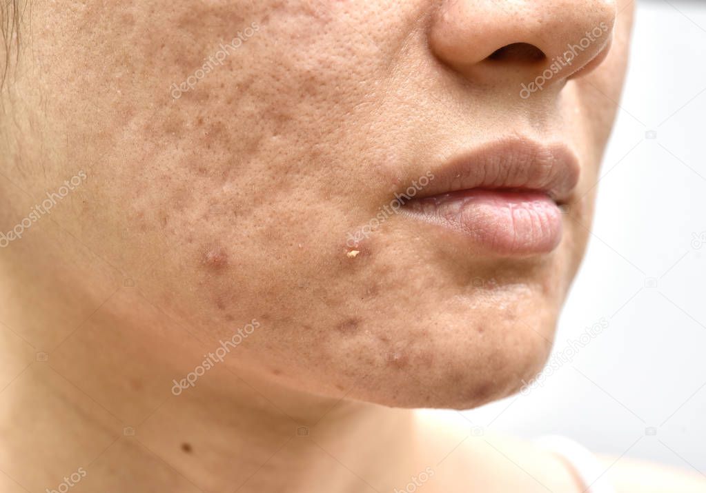 Skin problem with acne diseases, Close up woman face with whitehead pimples, Menstruation breakout, Scar and oily greasy face, Beauty concept.