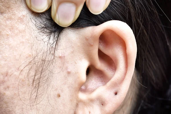 Skin Problem Acne Diseases Close Woman Face Whitehead Pimples Menstruation — Stock Photo, Image