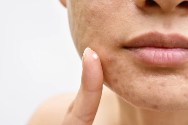 El acné y el problema de la piel de la cara, mujer que aplica la medicación de la crema del acné, tratamiento tópico de la droga del gel del grano . — Foto de Stock