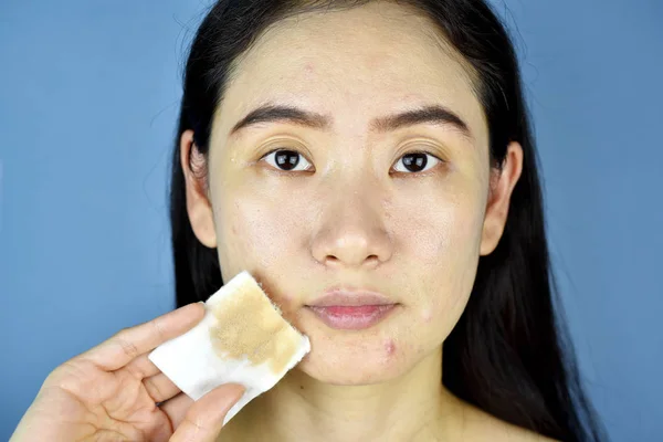 Extractor cosmético del maquillaje, cara asiática de la limpieza de la mujer con la almohadilla de algodón, piel desnuda de la cara y espinilla en la barbilla, acné cosmético . —  Fotos de Stock