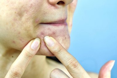 Acne pus, Close up photo of acne prone skin problem, Woman squeezing pimple with dirty bare hands, Removing whitehead acne from face and left lesion scar. clipart
