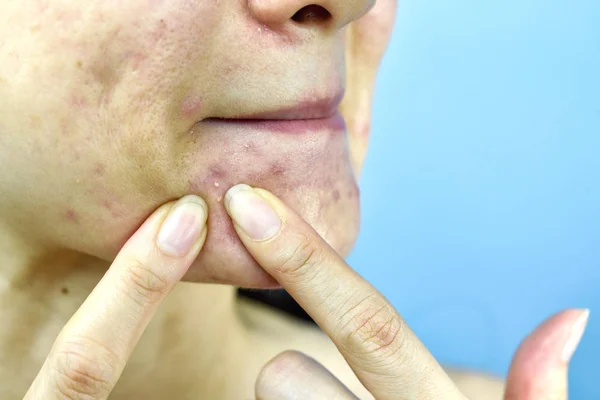 Acne pus, närbild foto av akne benägen hudproblem, kvinna klämma finne med smutsiga nakna händer, ta bort Whitehead akne från ansikte och vänster lesion ärr. — Stockfoto