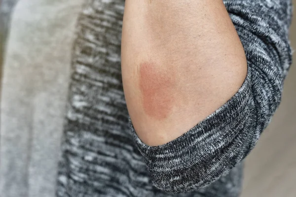 Malattie allergiche della pelle problema, Primo piano di dermatite atopica rash, Paziente dermatologia femminile con eczema allergico al braccio, Psoriasi ricorrente per debolezza e malsana . — Foto Stock