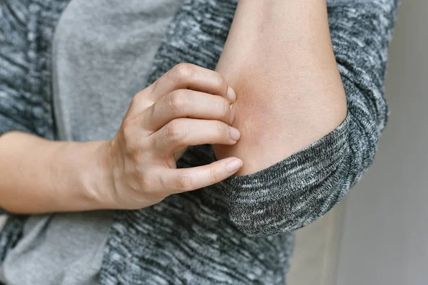 Kratzhaut Allergie Probleme, Nahaufnahme von Neurodermitis Hautausschlag, weibliche Dermatologie Patientin mit allergischem Ekzem am Arm, Psoriasis wiederkehrend durch Schwäche und ungesund. — Stockfoto