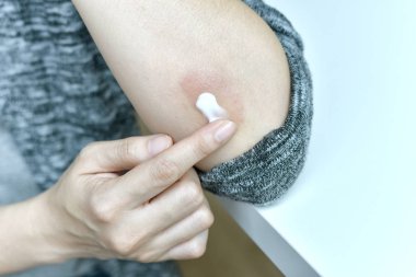 Cilt alerjisi hastalıkları sorunu, Atopik dermatit döküntüsi tedavisinin yakın çekim, Kolda alerjik egzama olan kadın dermatoloji hastası, sedef hastalığı halsizlik ve sağlıksız.