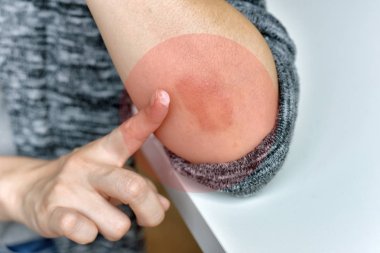 Cilt alerjisi hastalıkları sorunu, Atopik dermatit döküntüsü yakınlığı, Kolda alerjik egzama olan kadın dermatoloji hastası, sedef hastalığı halsizlik ve sağlıksız.