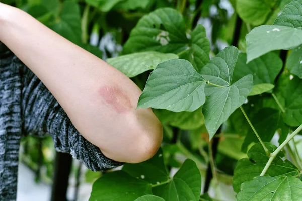 Болезни аллергии на кожу, сыпь от контакта с ядовитым деревом, женская дерматология, аллергическая экзема на руке — стоковое фото