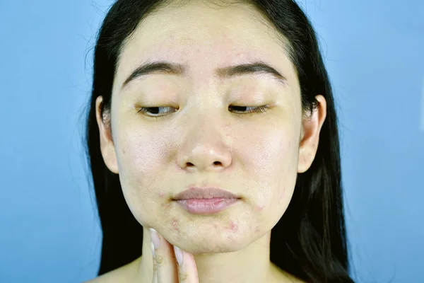 Problema facial de la piel de la cicatriz del acné, mujer asiática molesta y aburrida por las espinillas hormonales, mano de chica joven apuntando a su barbilla, piel sensible e irritada propensa . —  Fotos de Stock