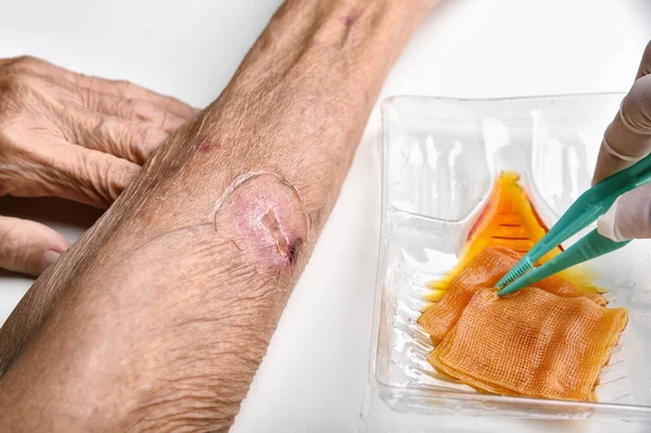 Wound dressing, Doctor cleaning and wash infected wound in chronic diabetes patient with normal saline and povidone iodine, Accidental wound care treatment in elder old man.