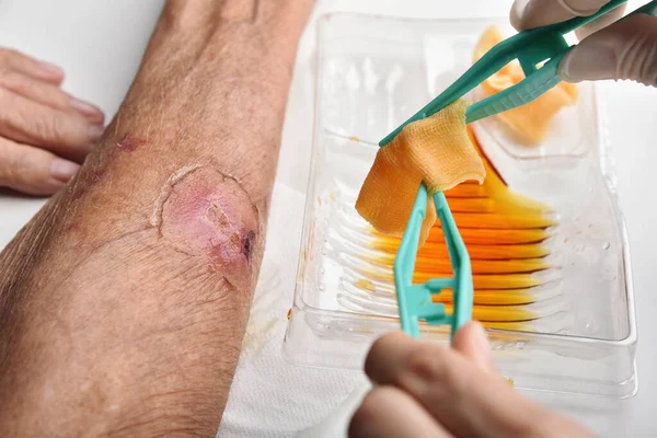 Wound dressing, Doctor cleaning and wash infected wound in chronic diabetes patient with normal saline and povidone iodine, Accidental wound care treatment in elder old man.