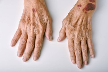 Yaşlı kadının deforme olmuş elleri, deri kanaması, morarmış yara ve bunamış purpurpura, yaşlı insanların eklem iltihabı yüzünden parmak ağrısı ve sertliği, yaşlı sağlık hizmetleri kavramı..