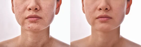Problemas Piel Cicatriz Del Acné Antes Después Del Tratamiento Facial —  Fotos de Stock
