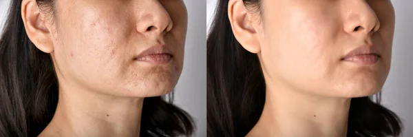Hautprobleme Und Akne Narben Behandlung Vor Und Nach Akne Gesichtspflege — Stockfoto