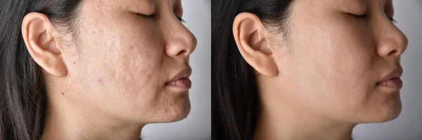 Problemas Piel Cicatriz Del Acné Antes Después Del Tratamiento Facial — Foto de Stock