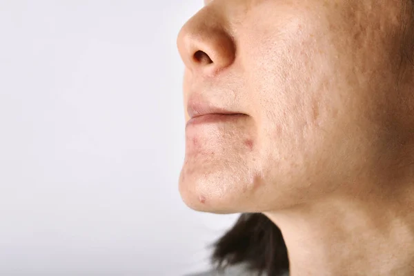 Hautproblem Mit Akne Erkrankungen Nahaufnahme Des Gesichts Einer Asiatischen Frau — Stockfoto
