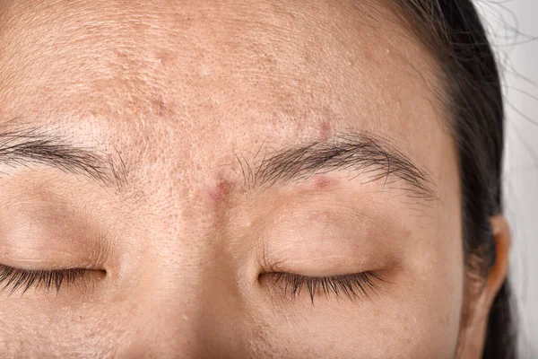 Gesichtshaut Problem Alterungsproblem Bei Erwachsenen Falten Akne Narben Große Poren — Stockfoto