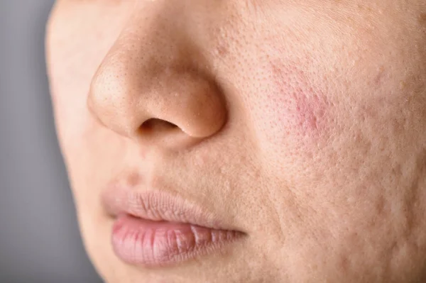 Skin Problem Acne Diseases Close Woman Face Acne Marks Allergy — Stock Photo, Image