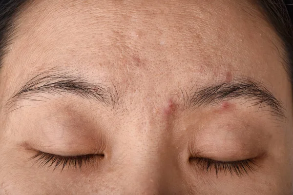 Problema Piel Facial Problema Envejecimiento Adultos Arrugas Cicatriz Acné Poro Fotos De Stock Sin Royalties Gratis