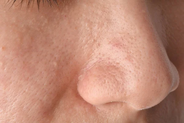 Greasy oily face and comedones, Skin problem with acne scar diseases, Close up woman face with blackhead pimples on nose.