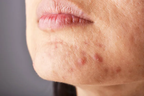 Skin Problem Acne Diseases Close Woman Face Whitehead Pimples Chin — Stock Photo, Image