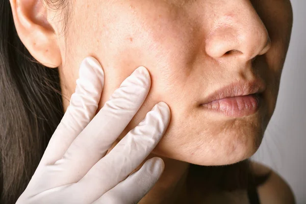 医者か皮膚科の手の検査の患者の顔 皮膚の問題とにきび跡 にきび顔のケアの治療 健康と美しさの概念 — ストック写真