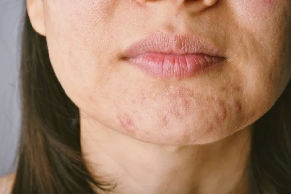 Problème Peau Avec Les Maladies Acné Gros Plan Visage Femme — Photo