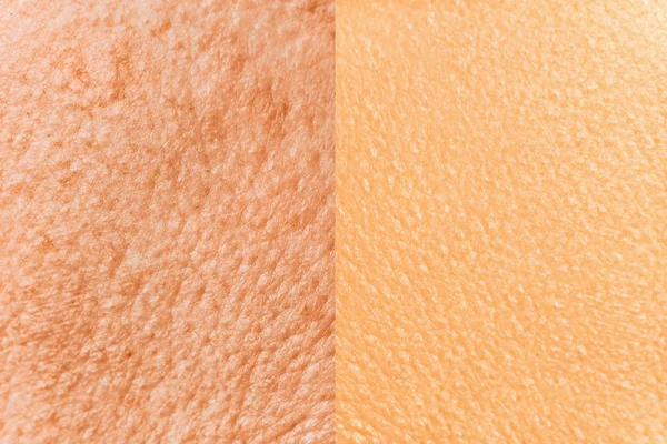 Anti-aging prosedürü öncesi ve sonrası yüz cilt