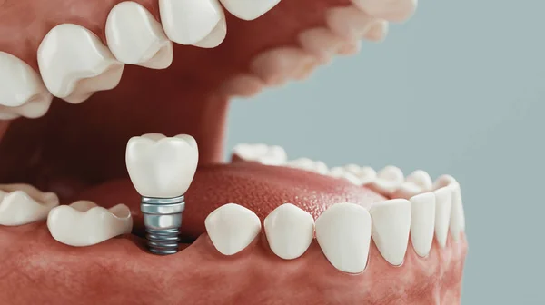 Cure Dentali Rendering — Foto Stock