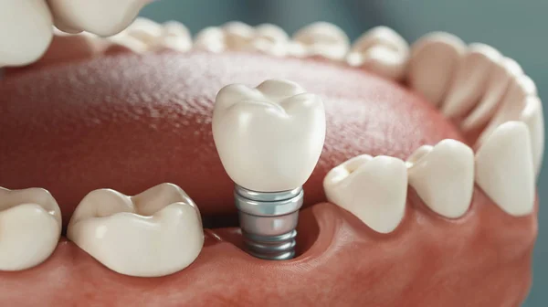 Cure Dentali Rendering — Foto Stock