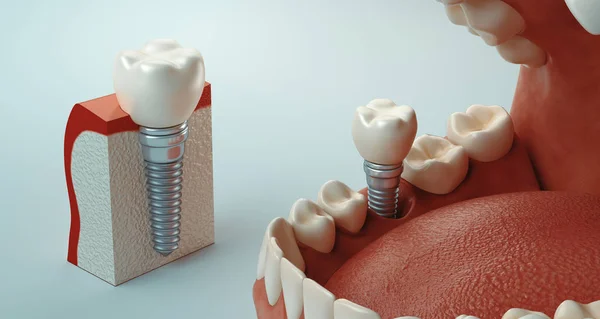 歯科治療 3Dレンダリング — ストック写真