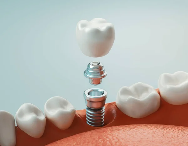 Diş bakımı, dental implant, 3d render