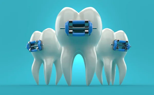 Zahn Mit Zahnspange Auf Blauem Hintergrund Illustration — Stockfoto