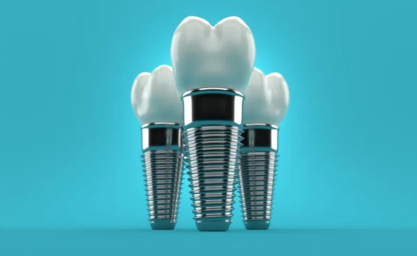 Implantes Dentales Sobre Fondo Azul Ilustración — Foto de Stock