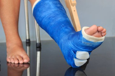 Alçılı alçıda kırık bacak ve arka planda hafif odaklanma. ışık üzerinde