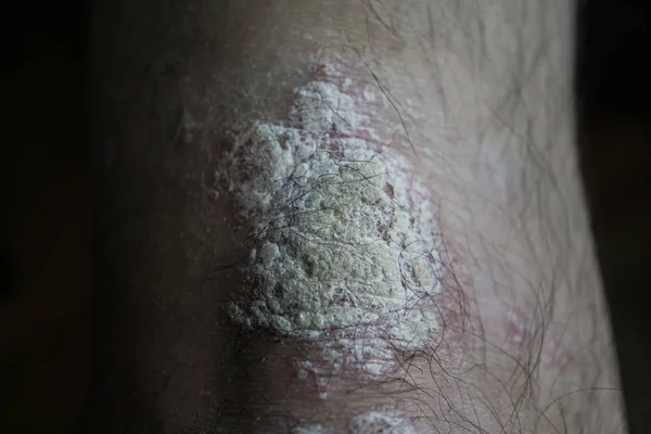 Psoríase Joelho Homem Caucasiano Doença Dermatológica — Fotografia de Stock