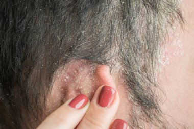 Sedef saç çizgisi ve kafa derisi-yakından, dermatolojik hastalıklar, cilt sorunları.